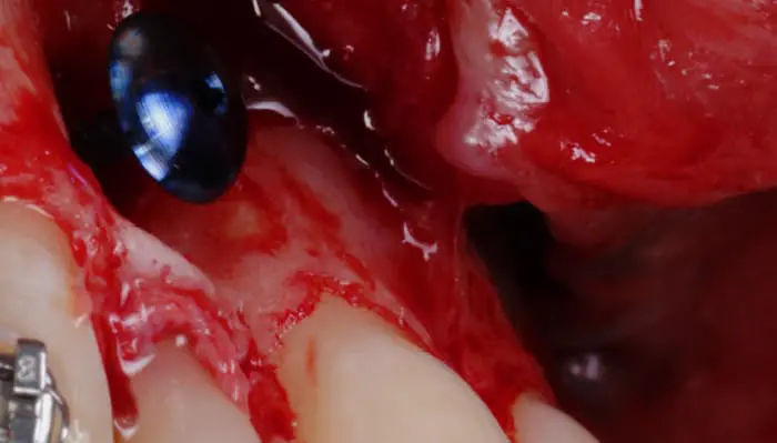 implanteperio_reconstruction-surgery-01