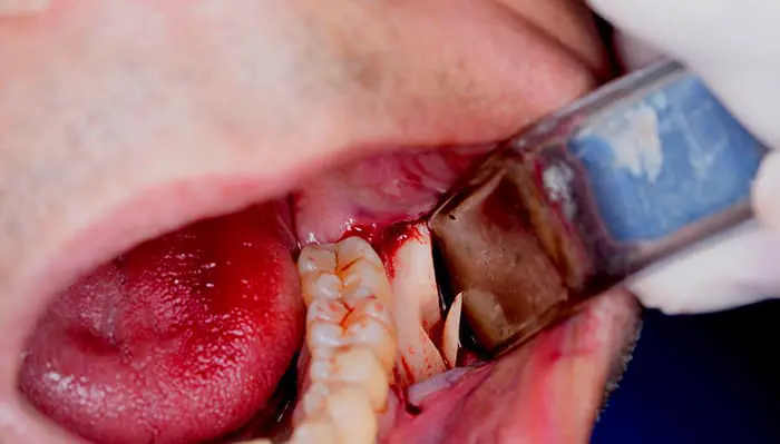 implanteperio_reconstruction-surgery-03