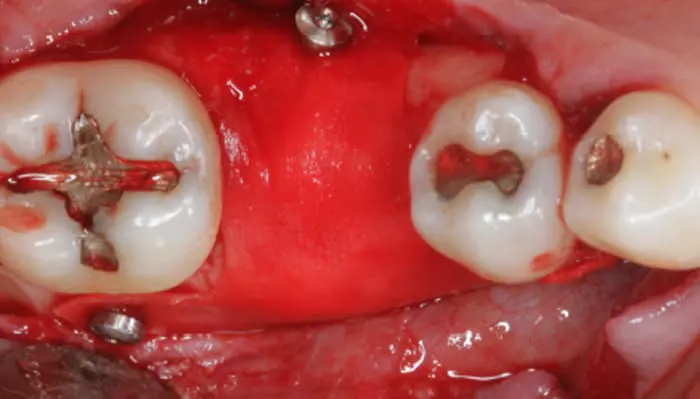 implanteperio_reconstruction-surgery-06