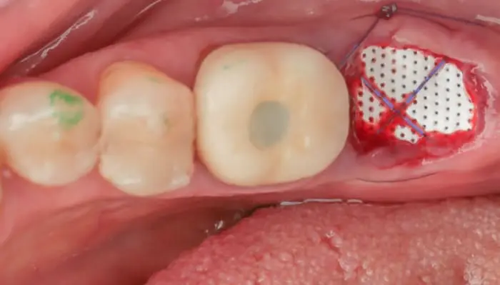 implanteperio_reconstruction-surgery-16