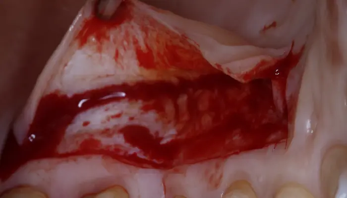 implateperio_soft-tissue-master-course-11